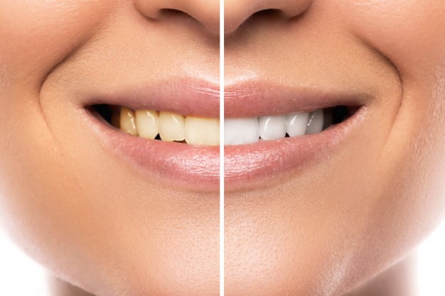Different Teeth Whitening Methods And Their Results